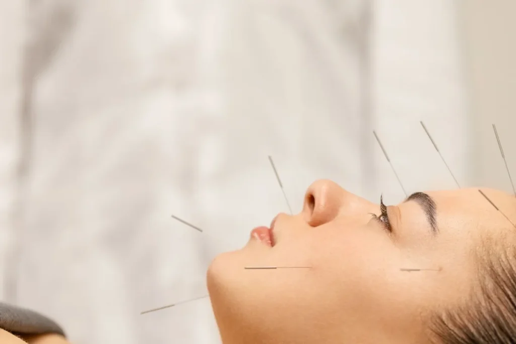 Acupuncture Needle Types